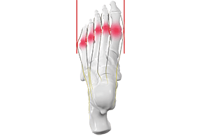 Fatigued foot muscles constrict vessels and nerves
